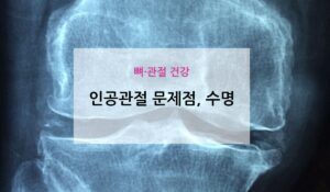 무릎 인공관절 재수술