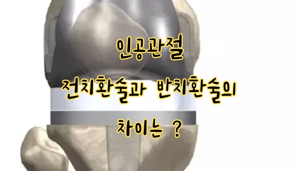 고관절 인공관절 수술 고관절 인공관절 수술