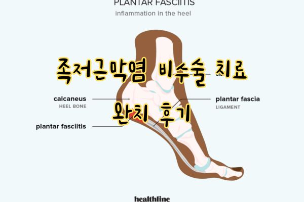 족저근막염 치료방법 및 후기