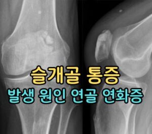 슬개골 통증 원인 슬개 대퇴 통증 증후군
