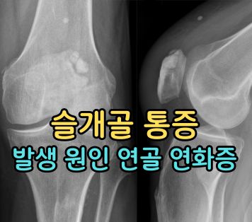 슬개골 통증 원인 슬개 대퇴 통증 증후군