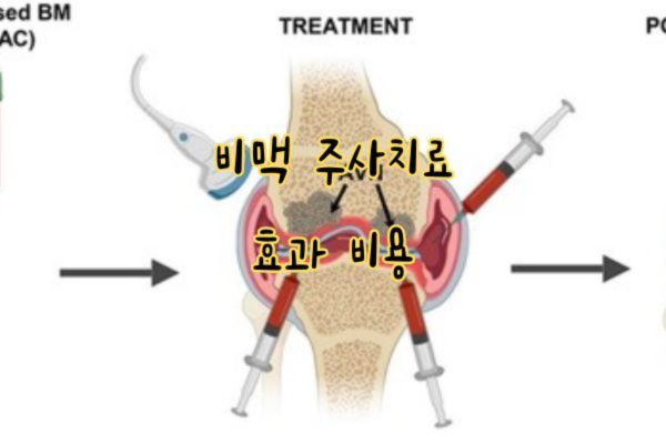 비맥 주사 비용 및 효과
