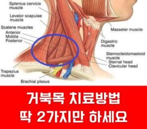 거북목교정 치료 2가지만 하세요 거북목교정 치료 2가지만 하세요