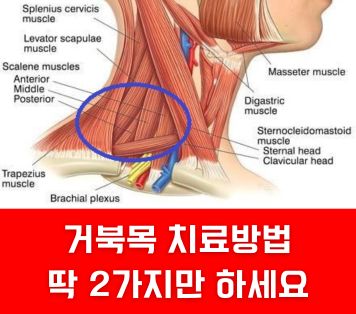 거북목교정 치료 방법 썸네일
