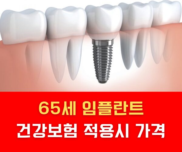 65세 임플란트 건강보험 적용시 가격